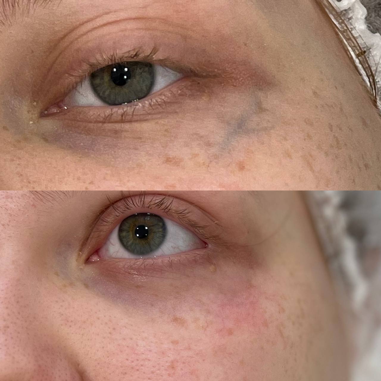 Лазерное удаление сосудов