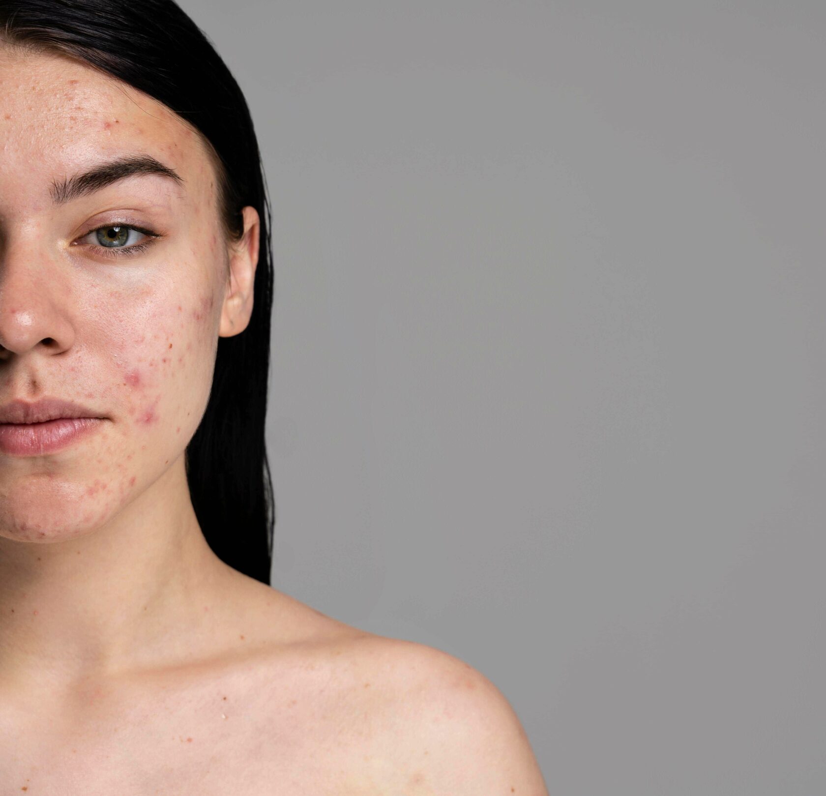 «Карта акне» на лице по зонам - Блог клиники "Левобережная" г. Москва