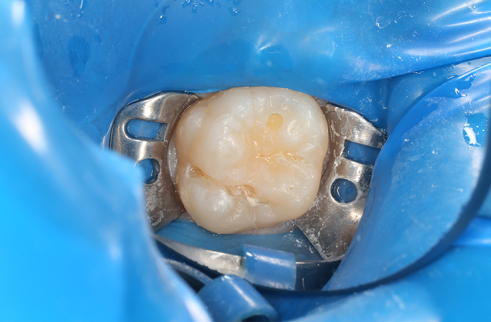 Своевременное лечение кариеса постоянного зуба у подростка без жалоб