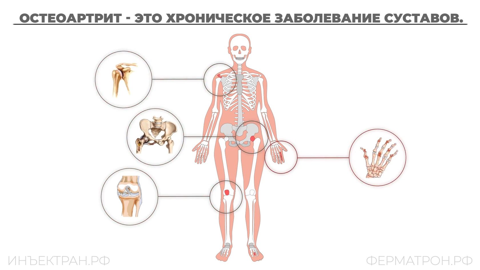 Ферматрон Для Суставов Где Купить