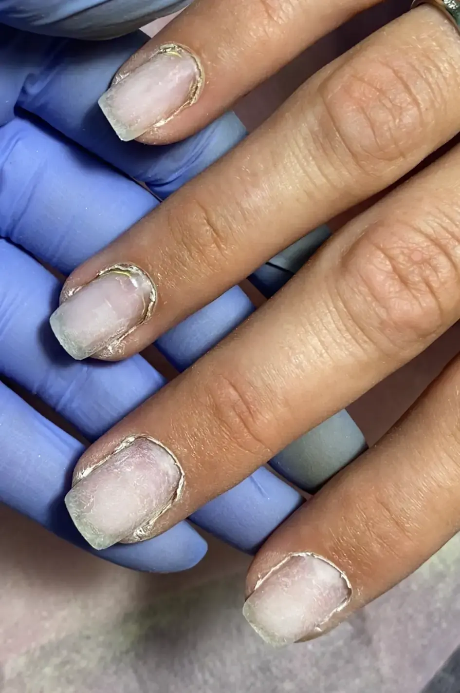 Открытая кутикула после поднятия пушером, видны пропилы и избыточный птеригий.