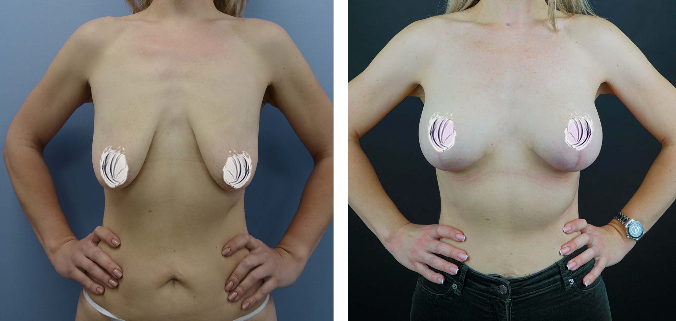 операция по подтяжке груди у женщин фото 10