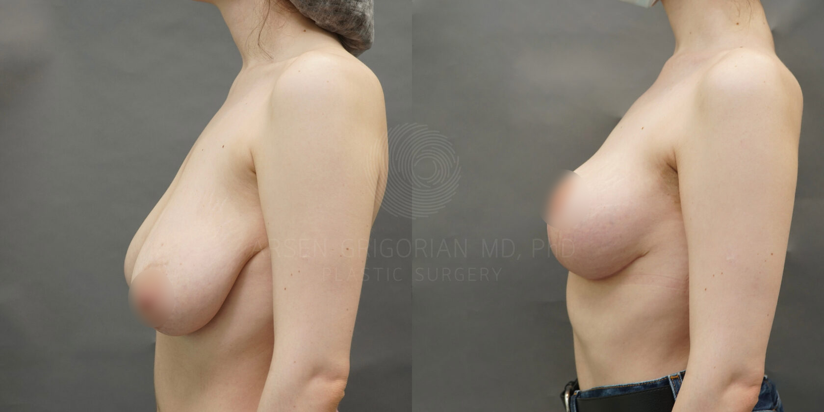уменьшение груди для мужчин фото 61
