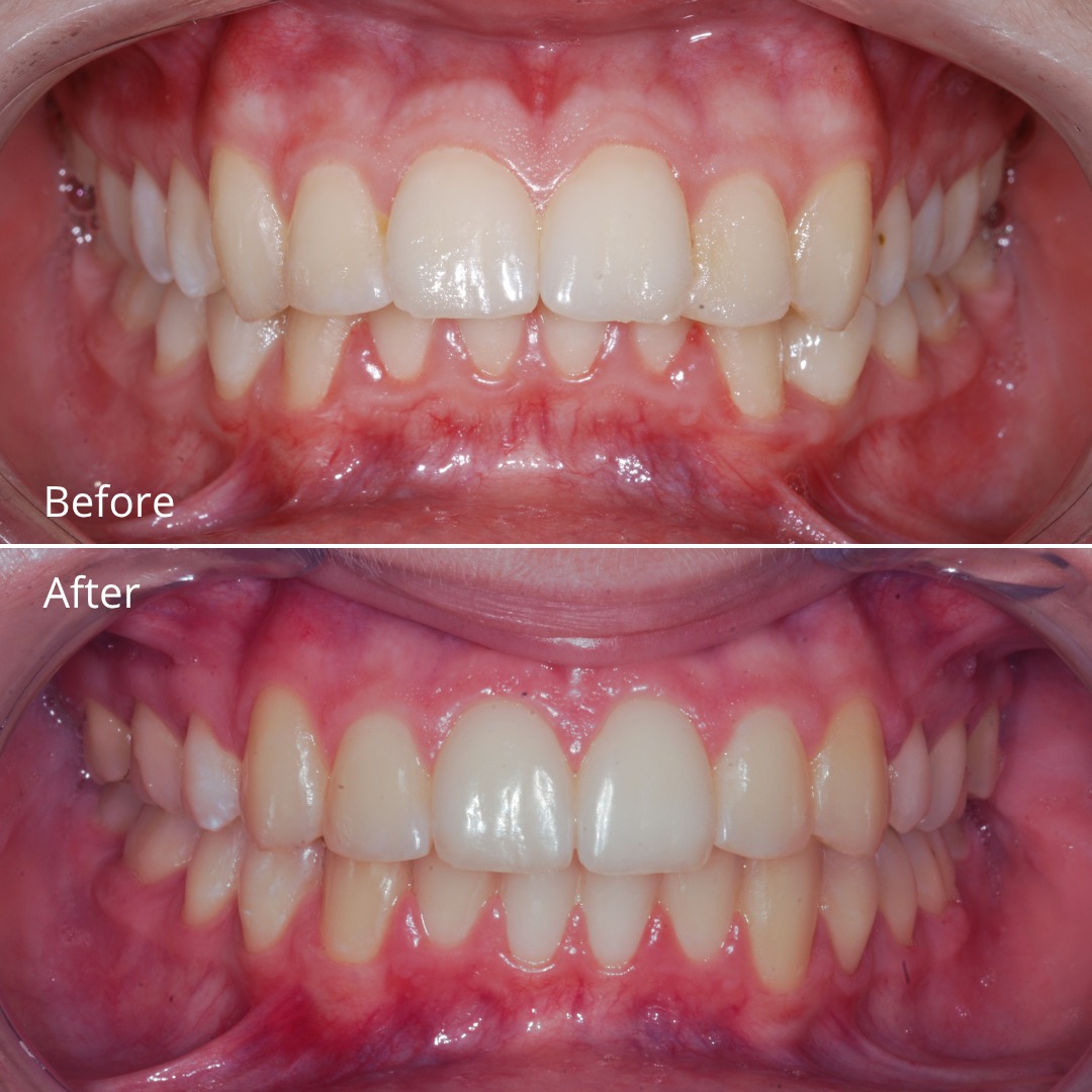 Stage showing space closure following premolar extraction — photo 2 of 6