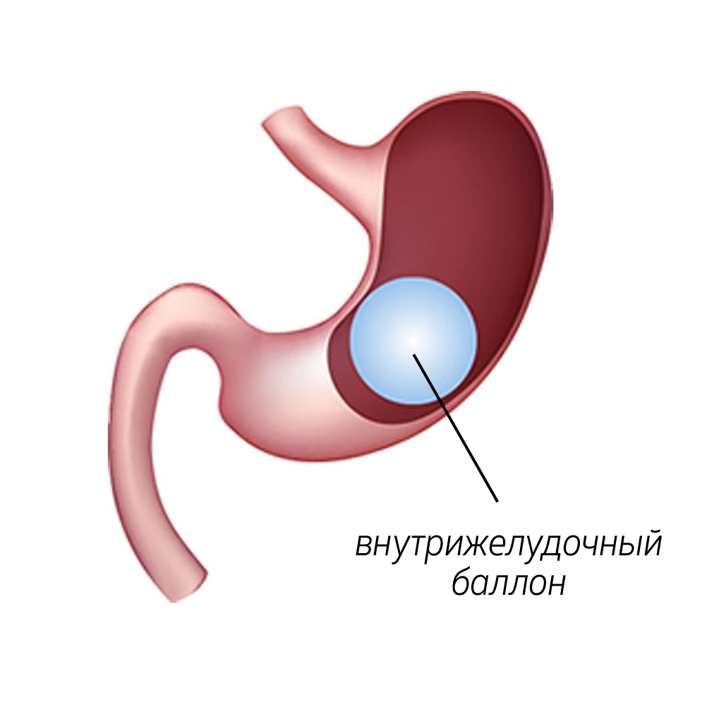 Установка баллона в желудок отзывы. Внутрижелудочный баллон. Баллонирование желудка для похудения. Внутрижелудочный баллон для похудения.