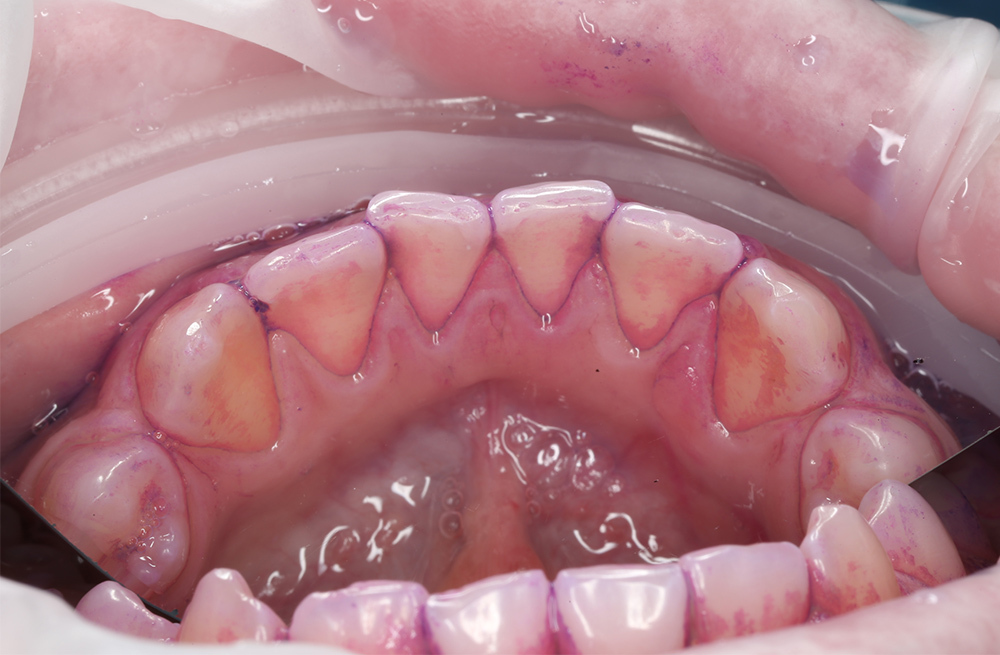 Профессиональная чистка зубов подростку 13 лет