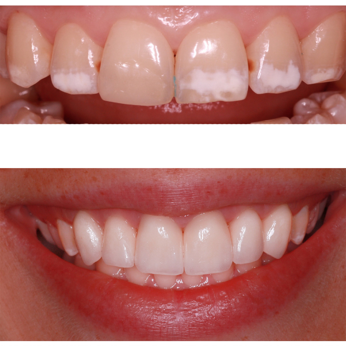 Авторская стоматология юлии ворониной. Сделать зубы пермь. Отбеливание зубов пермь. Сделать зубы пермь. Виниры snap on smile.