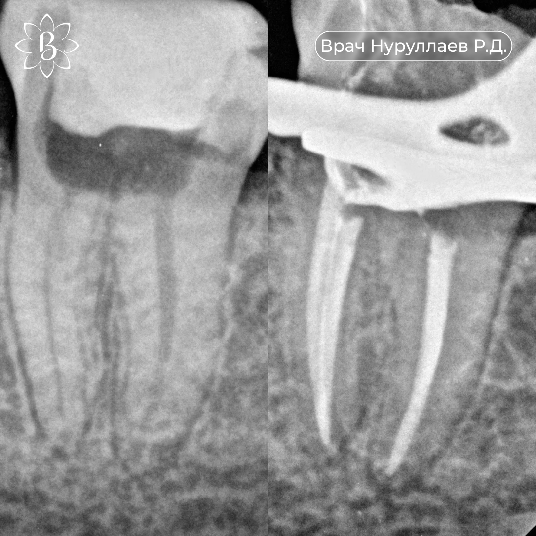 Лечение корневых каналов зуба.