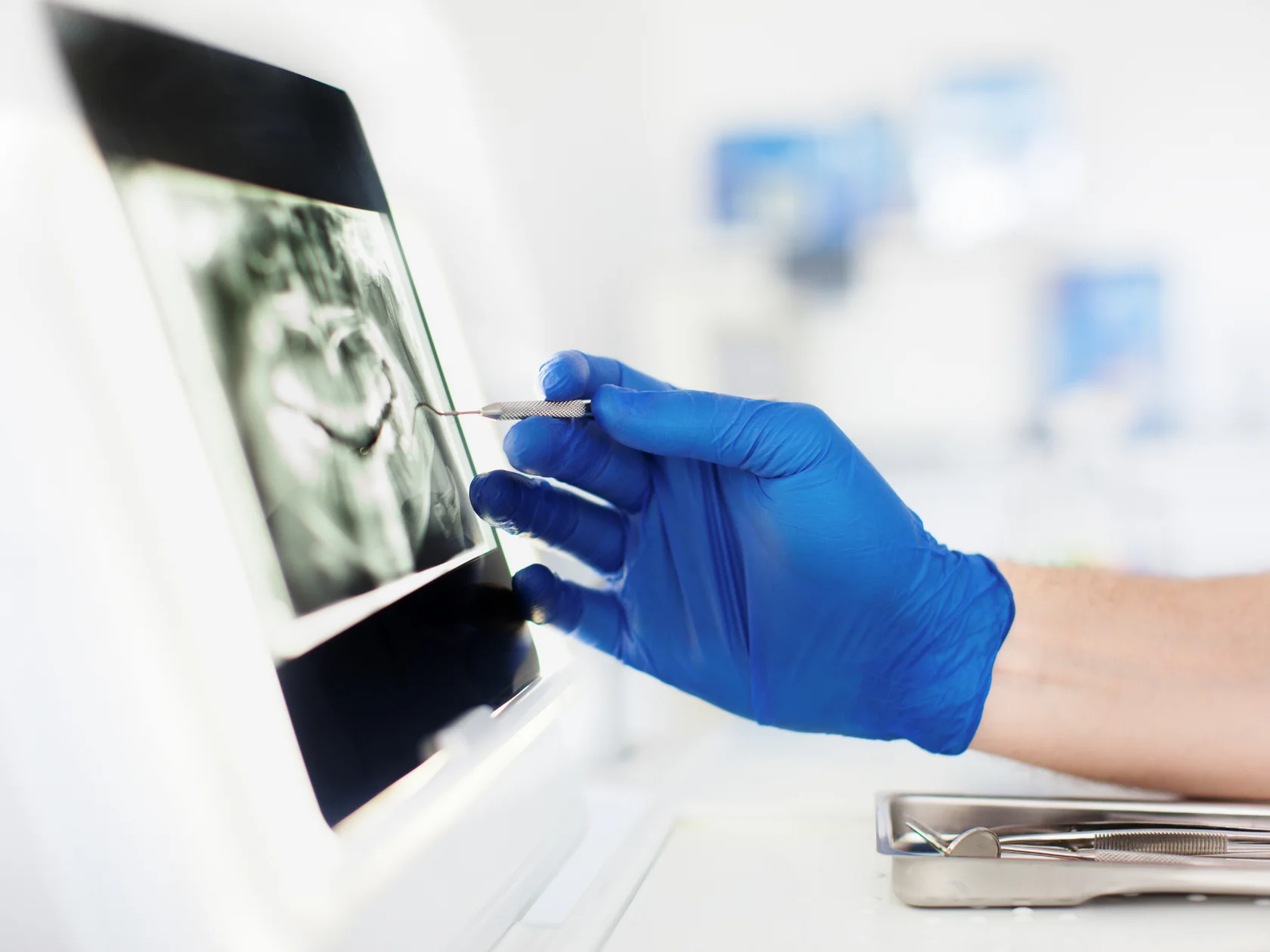 Стоматолог анализирует рентгеновский снимок зуба с кистой на экране — диагностика и лечение кисты зуба в клинике «Элегия» (Минск)