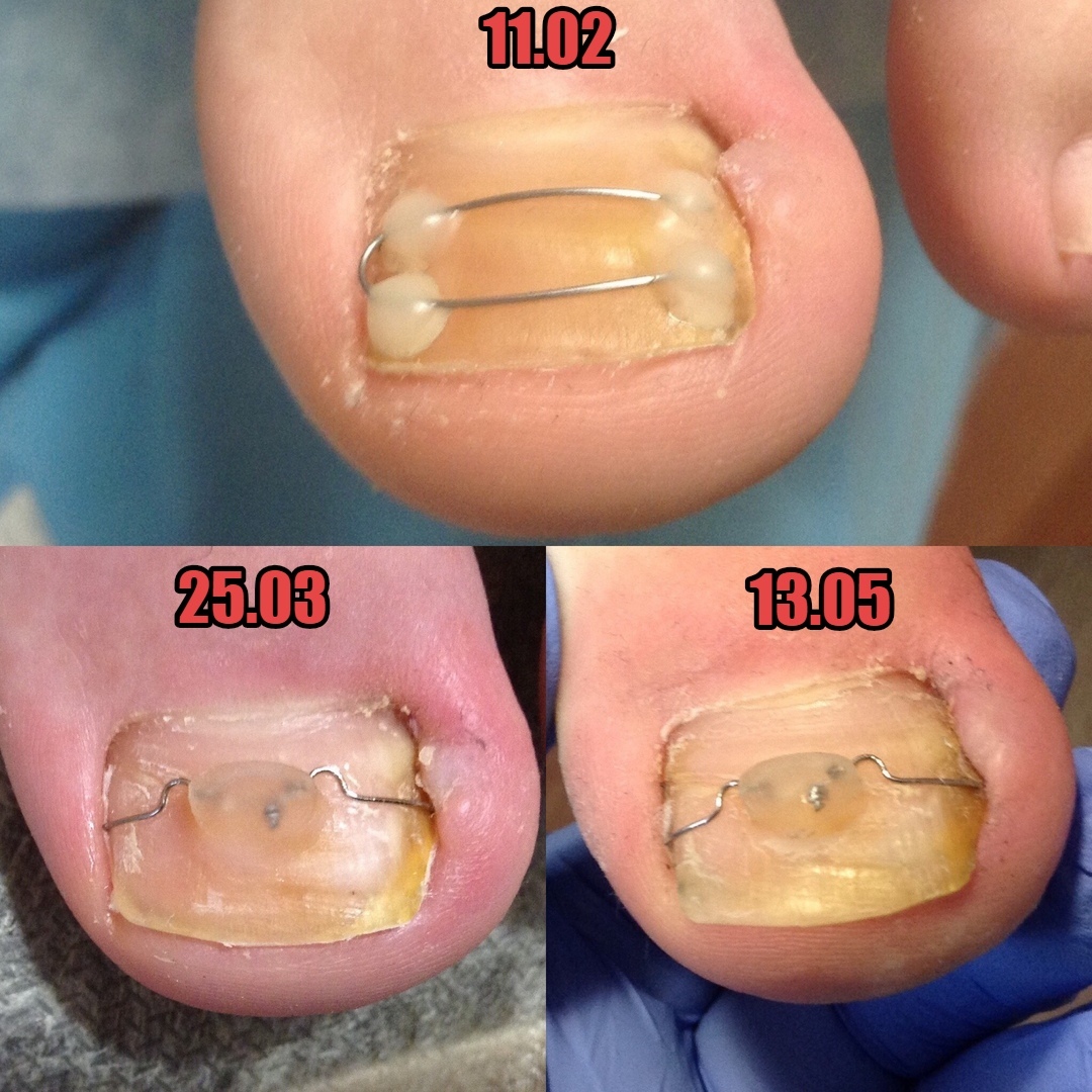 Помощь в работе с грибком