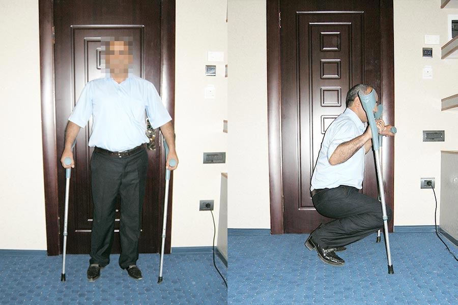 Лечение остеомиелита костей тазобедренного сустава