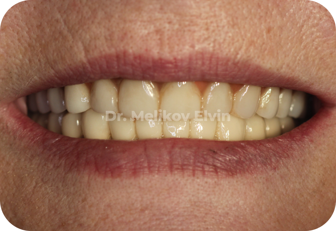 Имплантация зубов