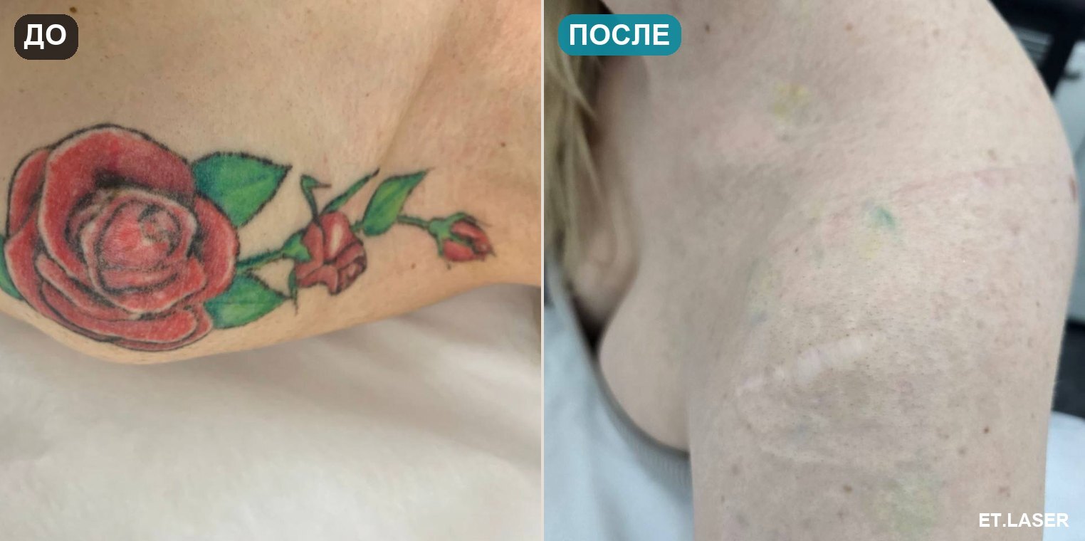 До и после: цветная роза на плече