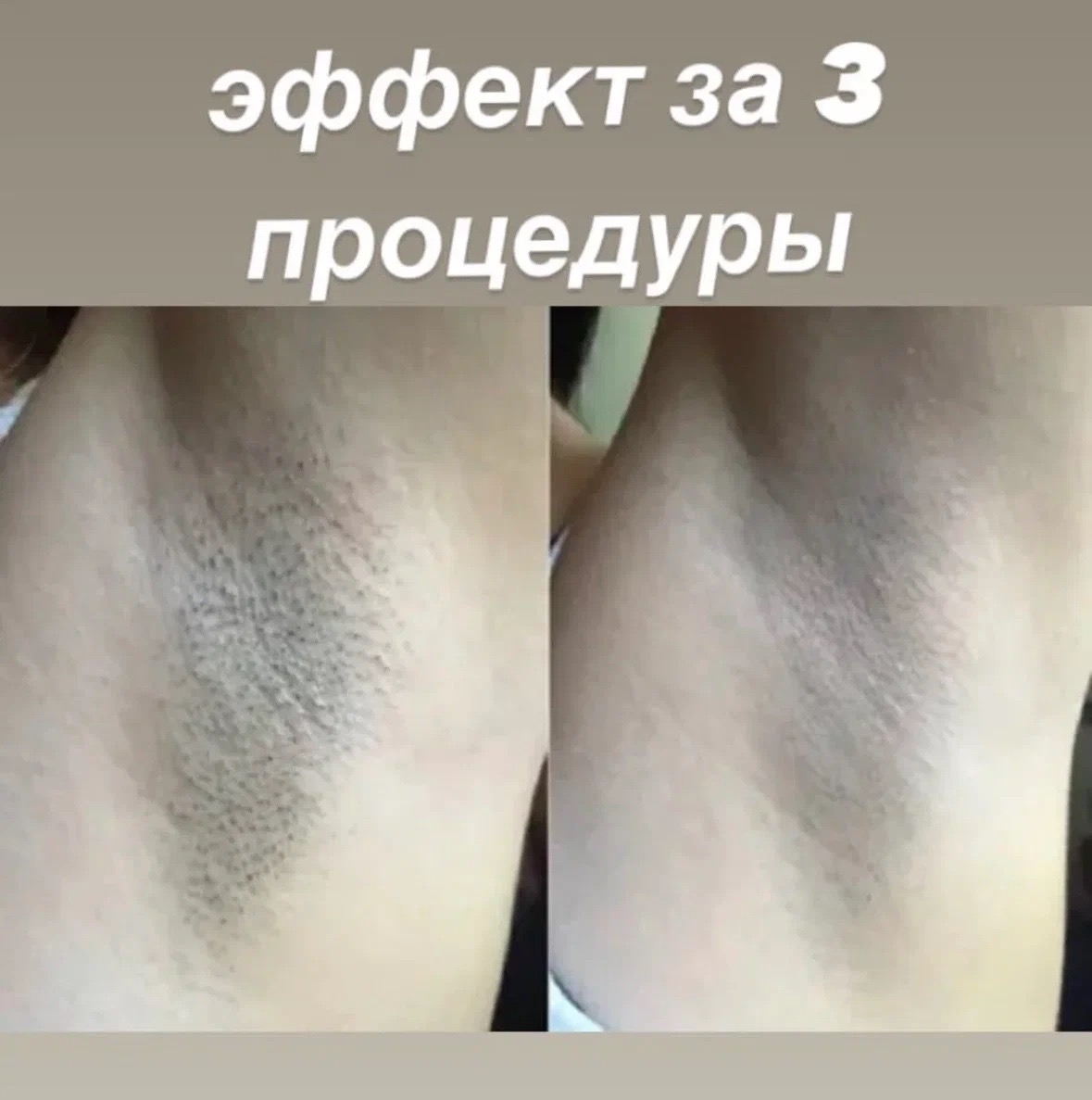До и после лазерной эпиляции подмышки