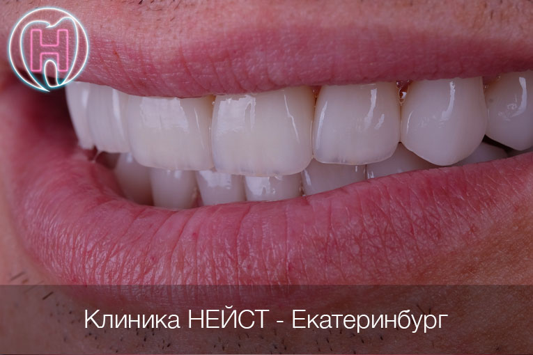 мужские керамические виниры в Екатеринбурге