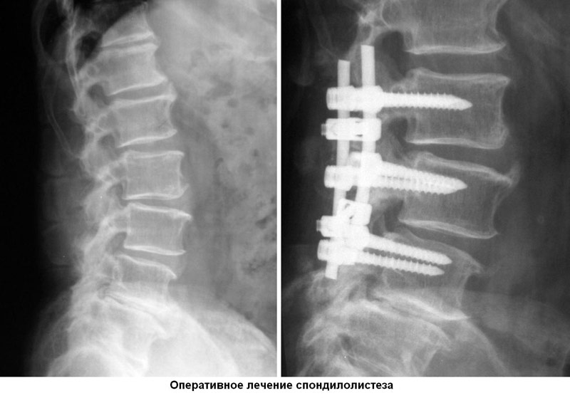 Спондилолистез | Симптомы, диагностика, лечение спондилолистеза ...