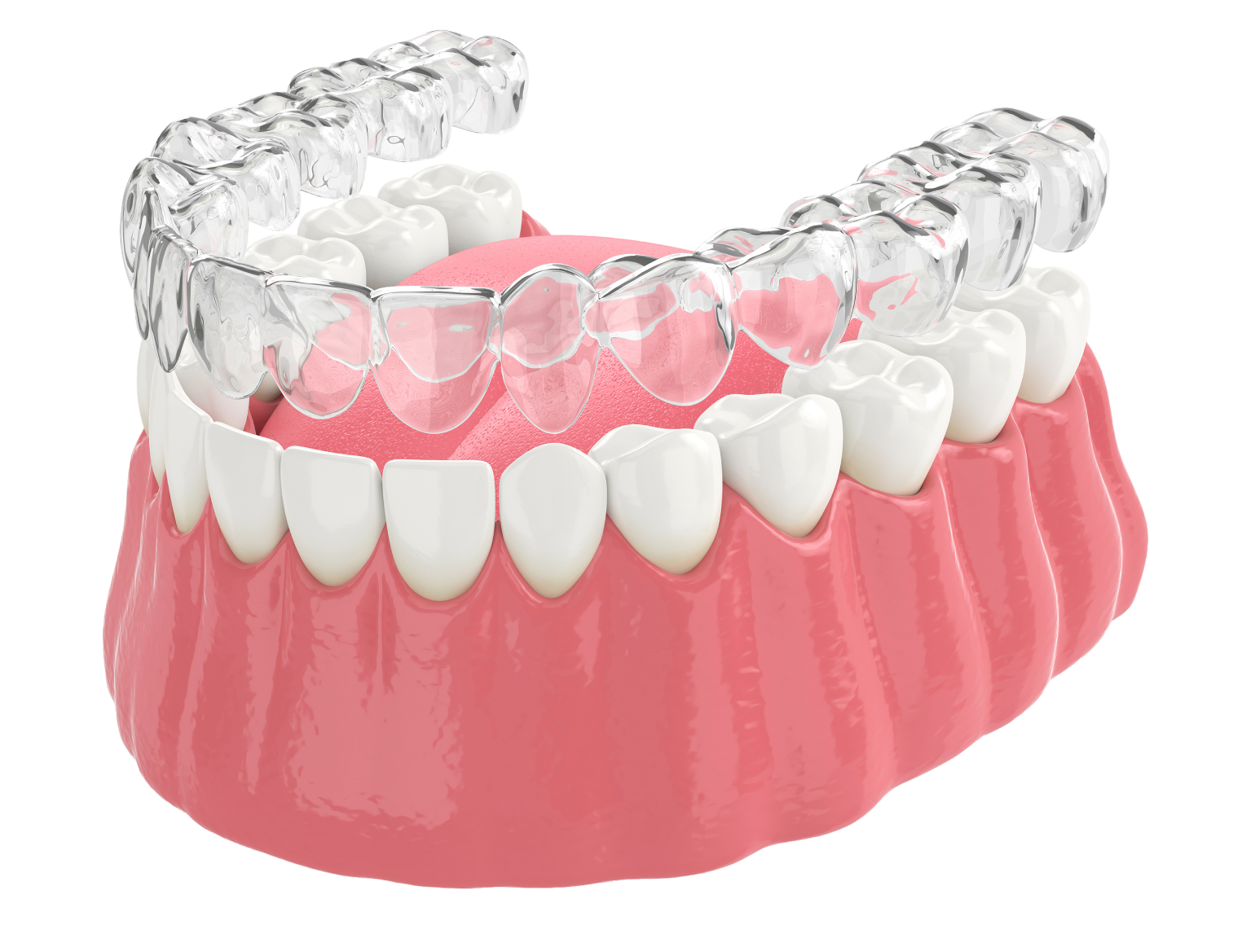 Установка имплантов в Дербенте. Имплантация при отсутствии одного зуба.