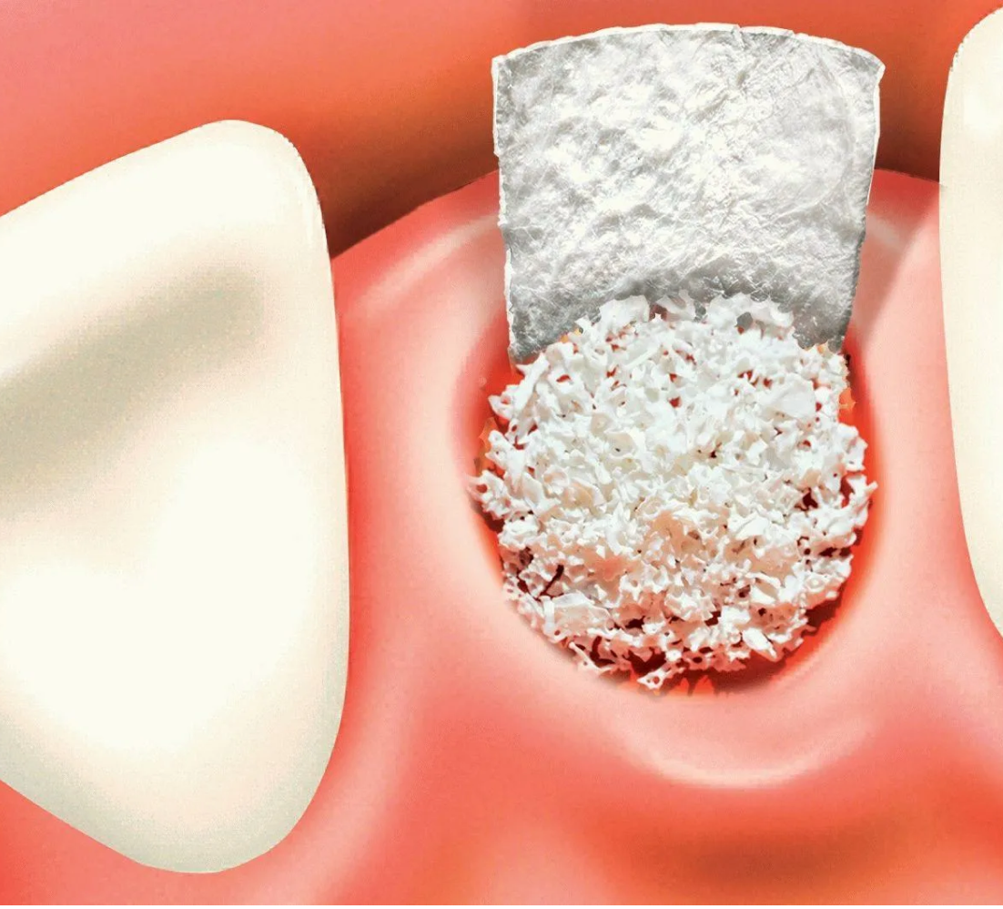 Костная ткань в стоматологии