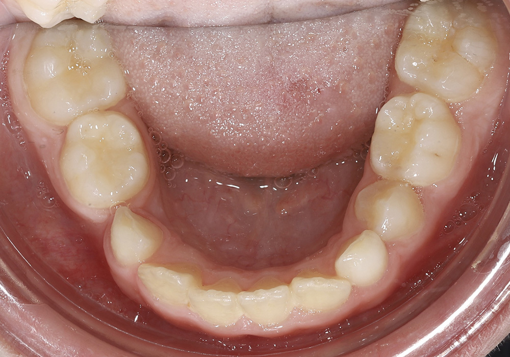 Коррекция дефицита пространства для постоянного зуба ортодонтическим методом