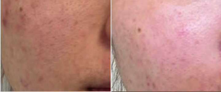 Покраснения до и после крема PLONTE