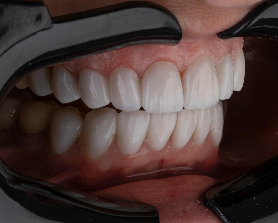 Можно ли восстановить зуб если он сильно поврежден?
