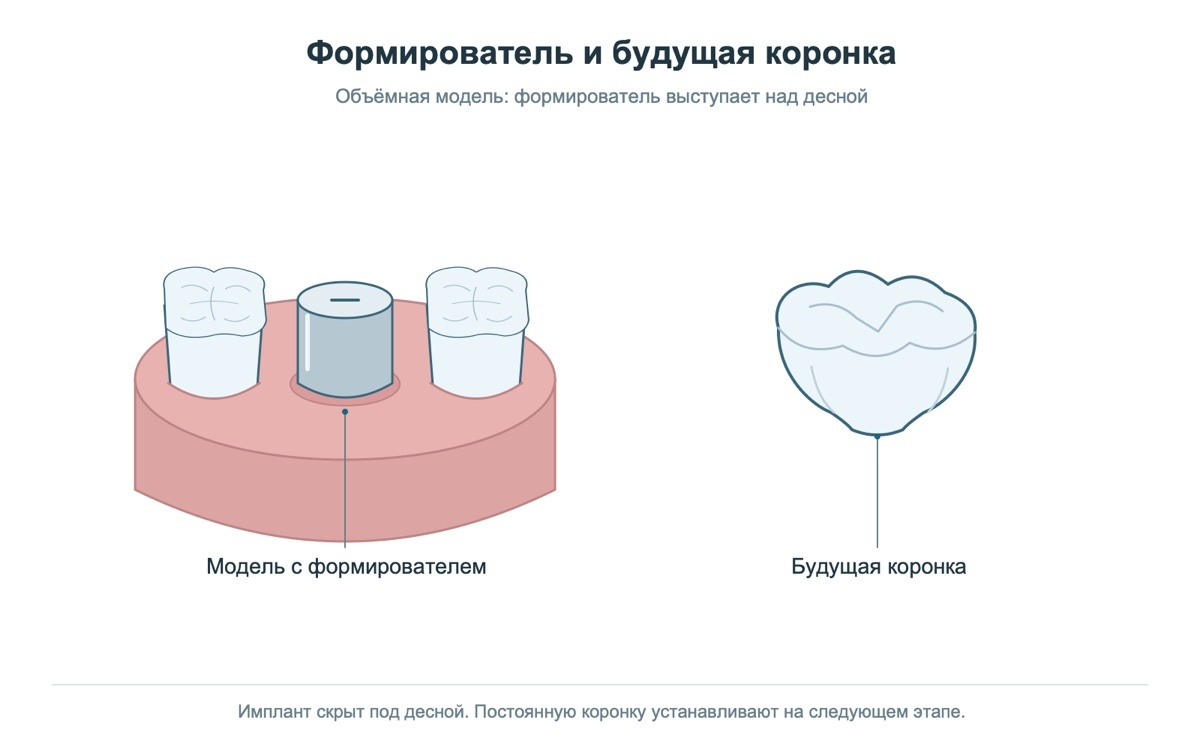Модель импланта с формирователем рядом с будущей коронкой