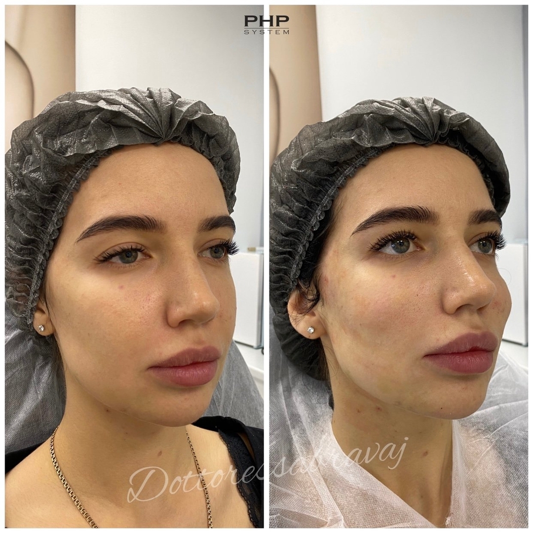Результат процедуры в PHP Косметология — до и после