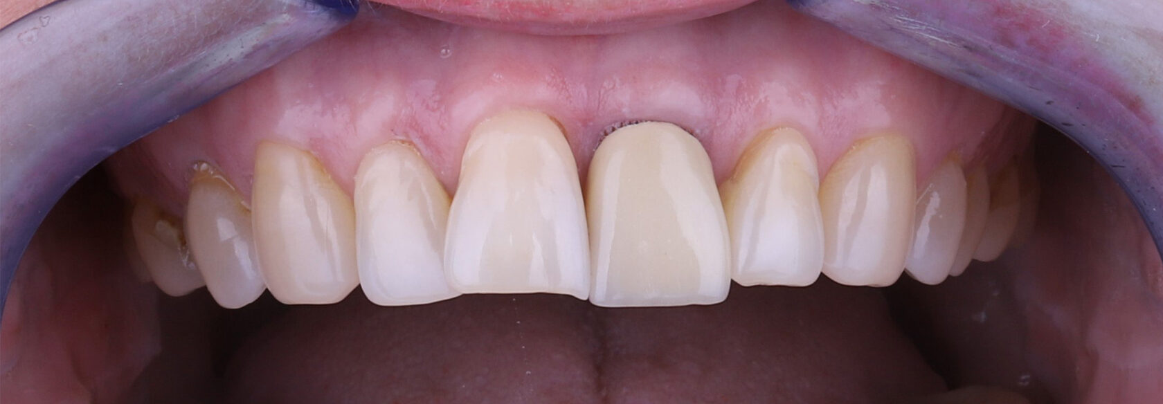 Комплексное восстановление переднего зуба после травмы с использованием импланта Осстем и протезированием с коронкой Emax