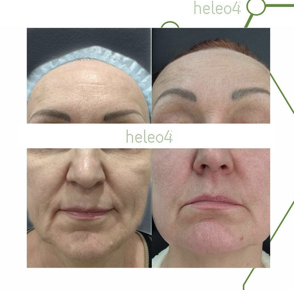 Heleo. Heleo4 аппарат. ФДТ heleo4. Фотодинамическая процедура heleo4.