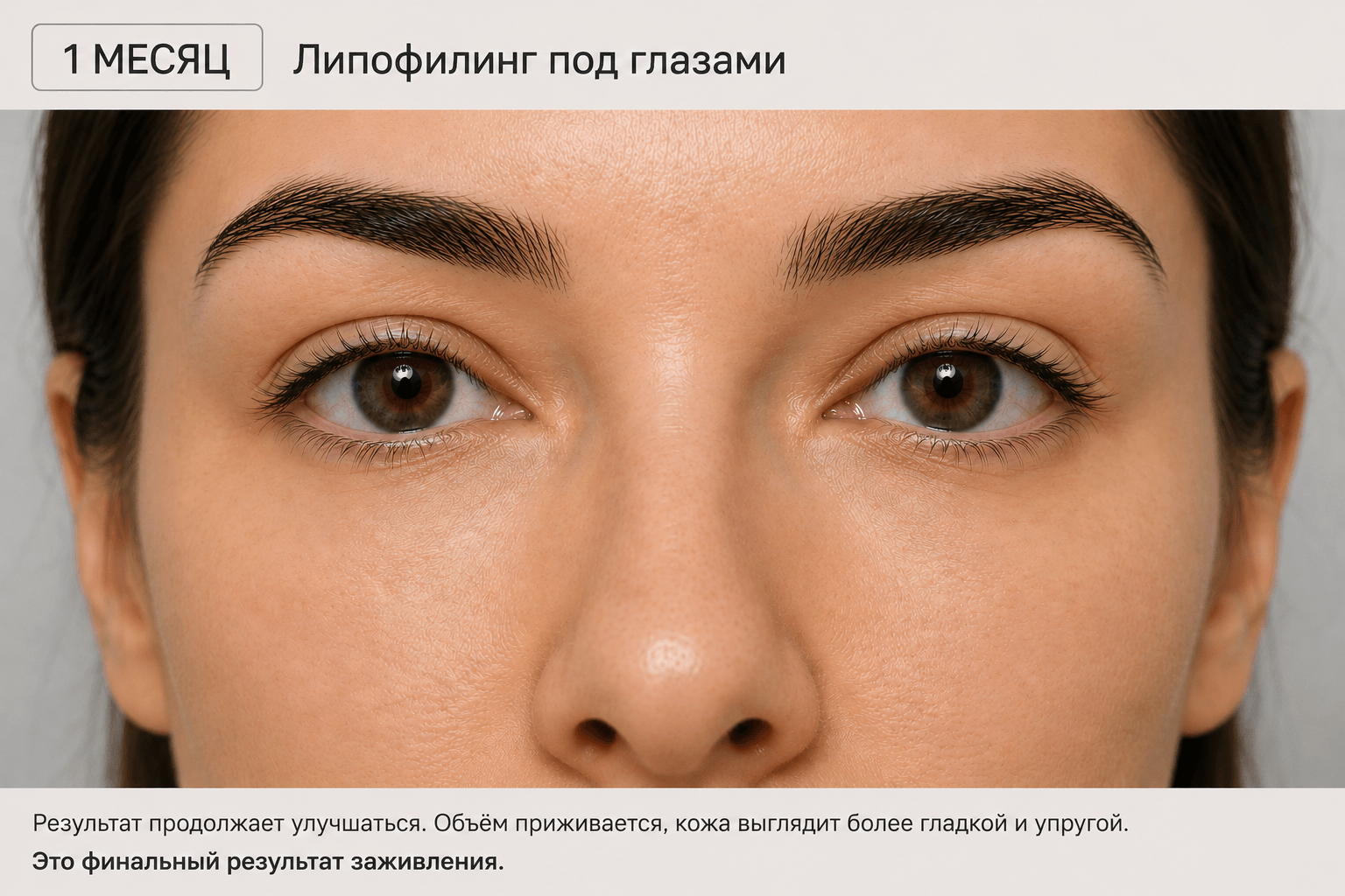 результат через месяц после липофилинга глаз