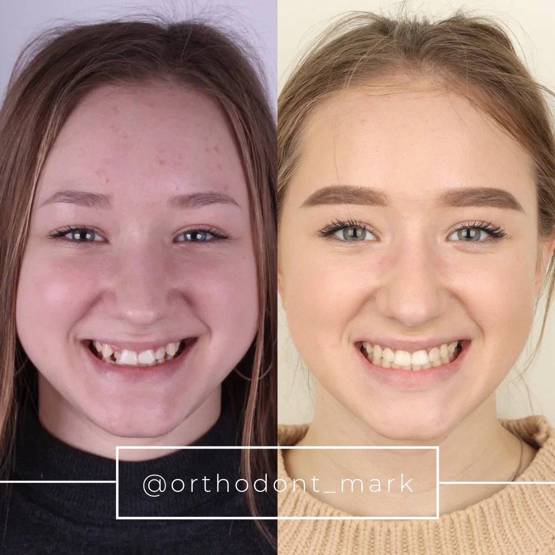 Skeletal Class III Correction with Expansion in a Teenage Patient
