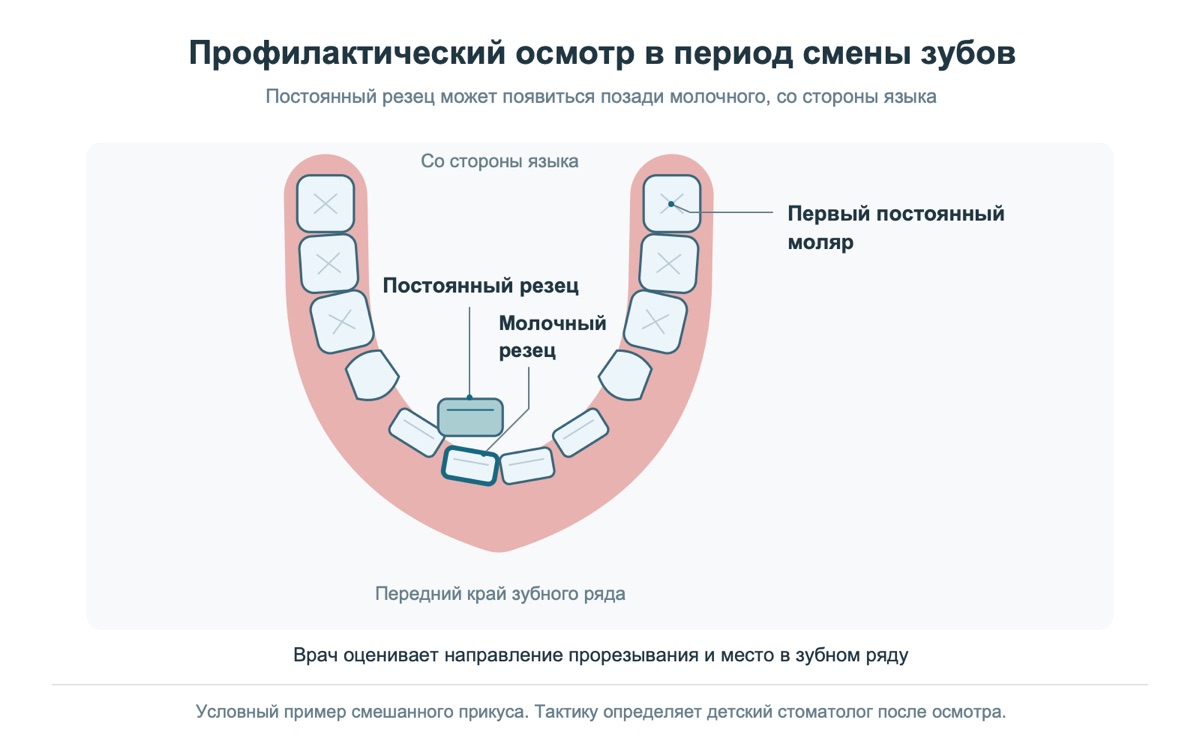 Постоянный резец прорезывается позади молочного: учебная модель нижней челюсти