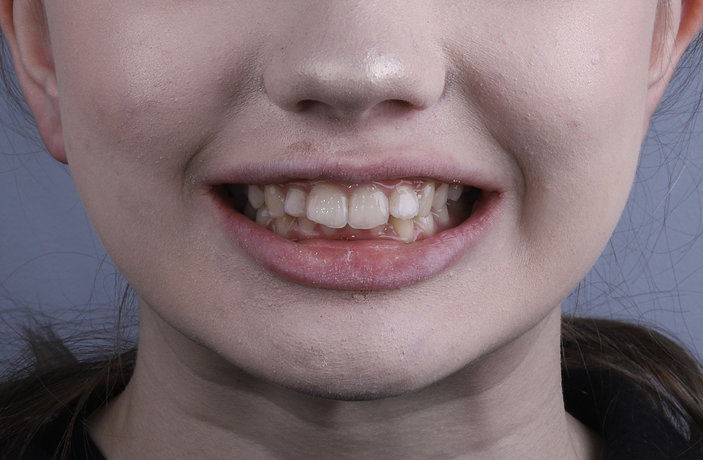 Коррекция прикуса и выравнивание зубов в подростковом возрасте