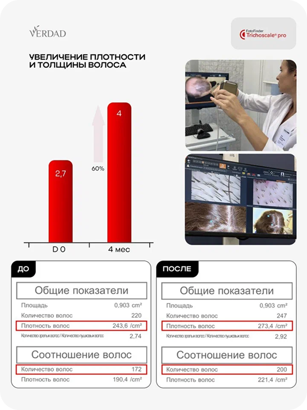 Результаты исследования VERDAD: увеличение плотности и толщины волос