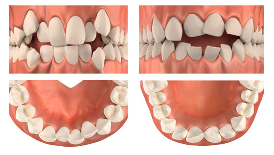 Виды некариозных поражений зубов