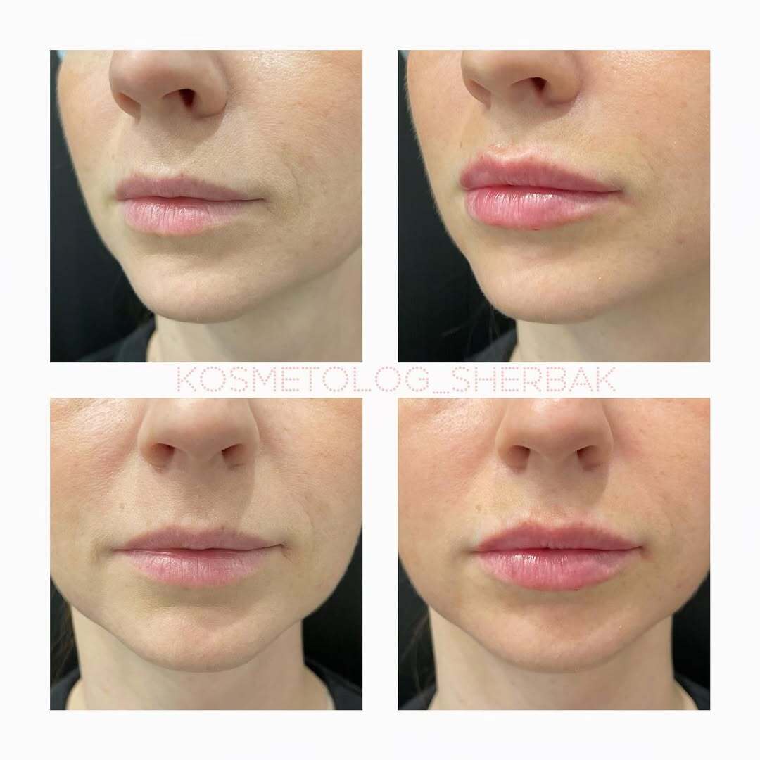 До и после контурной пластики губ. Увеличение объёма без утяжеления. PradusCOSMO, Васильевский остров