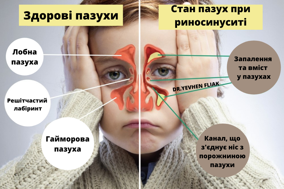 Сучасне лікування гаймориту (риносинуситів) у Львові | Фляк Євген