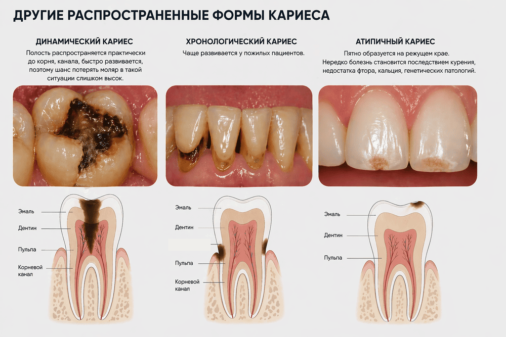 Виды кариеса