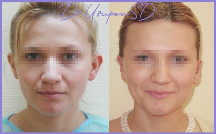 реабилитация после отопластики