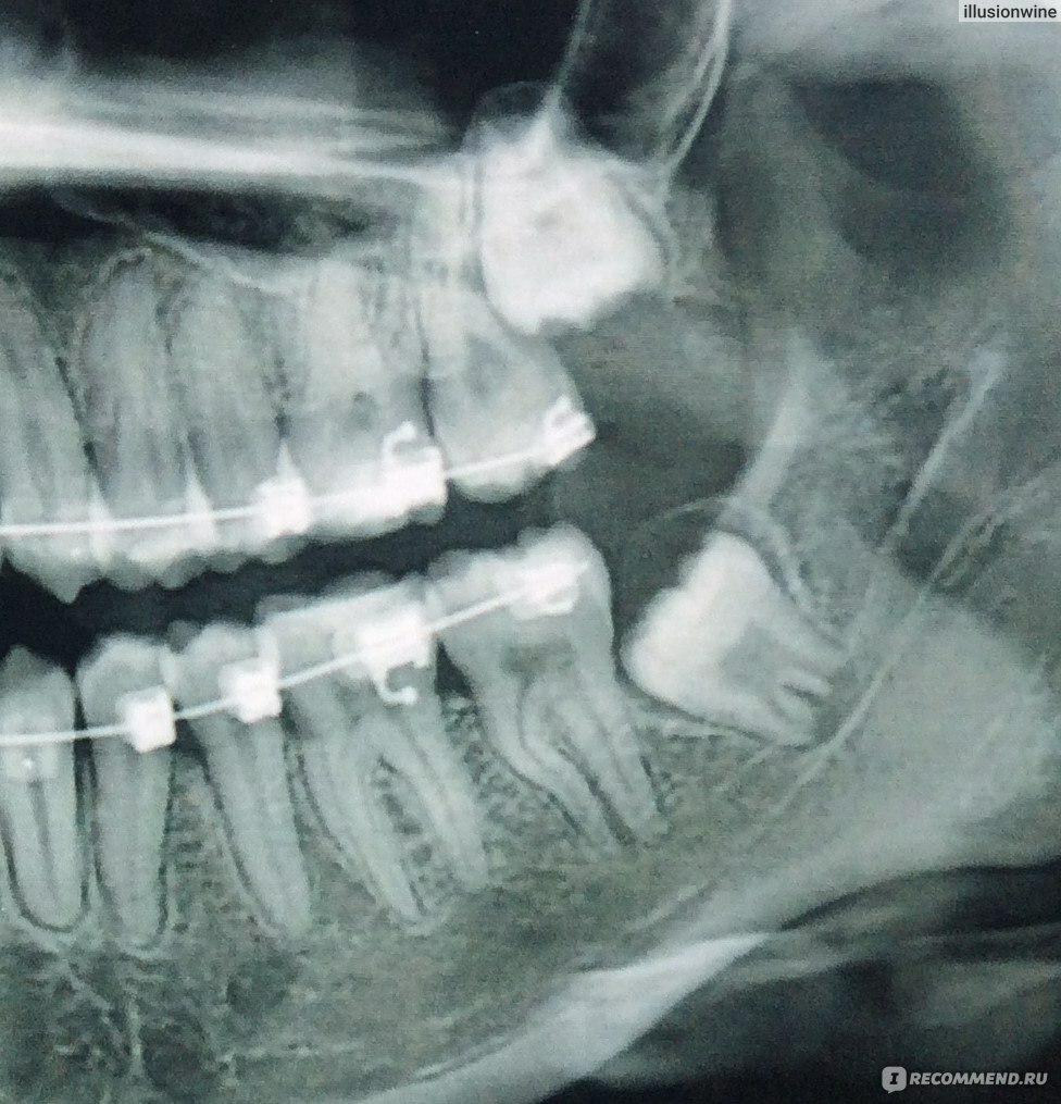 Решение проблем с зубами мудрости, запись на прием к стоматологу