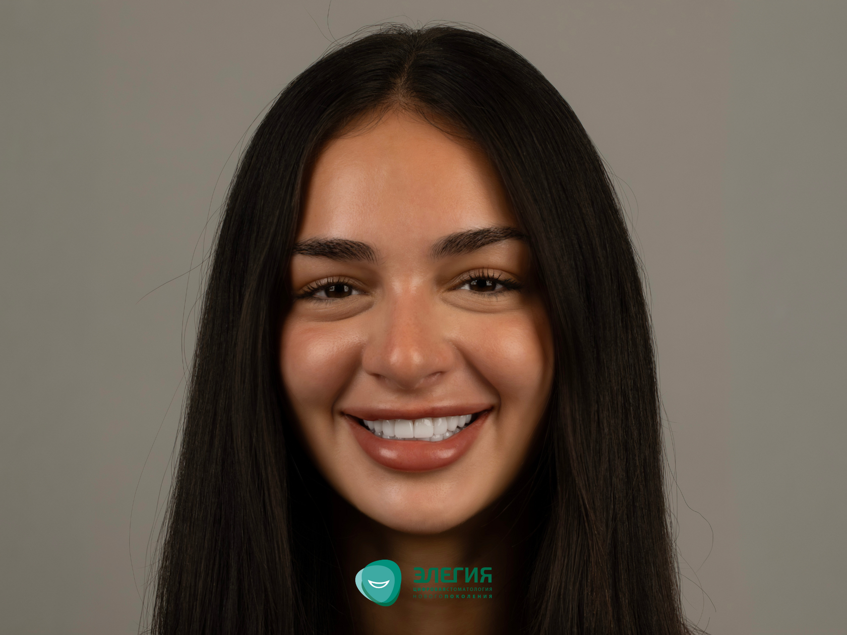 Улыбка пациентки после установки виниров отбеленного оттенка BL2