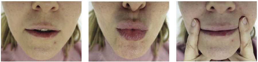 Отсроченные осложнения контурной пластики губ