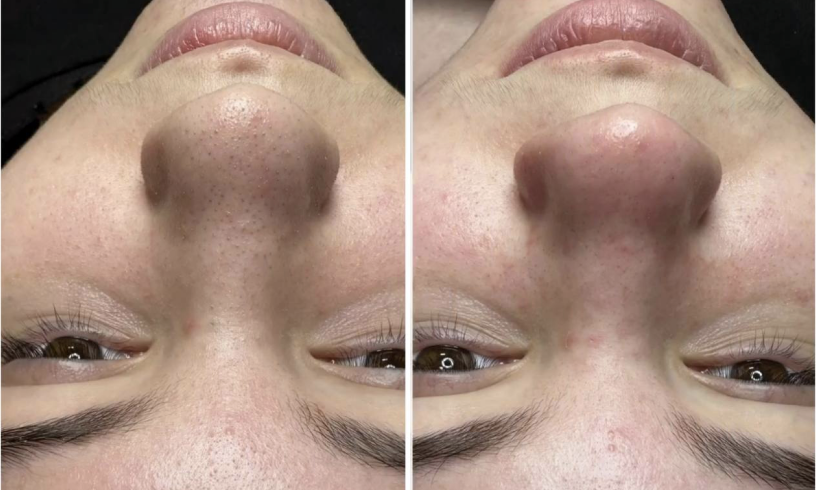 HydroDermabrasion before and after pores cleared blackheads Beauty Studio by Hanna Mount Pleasant SC