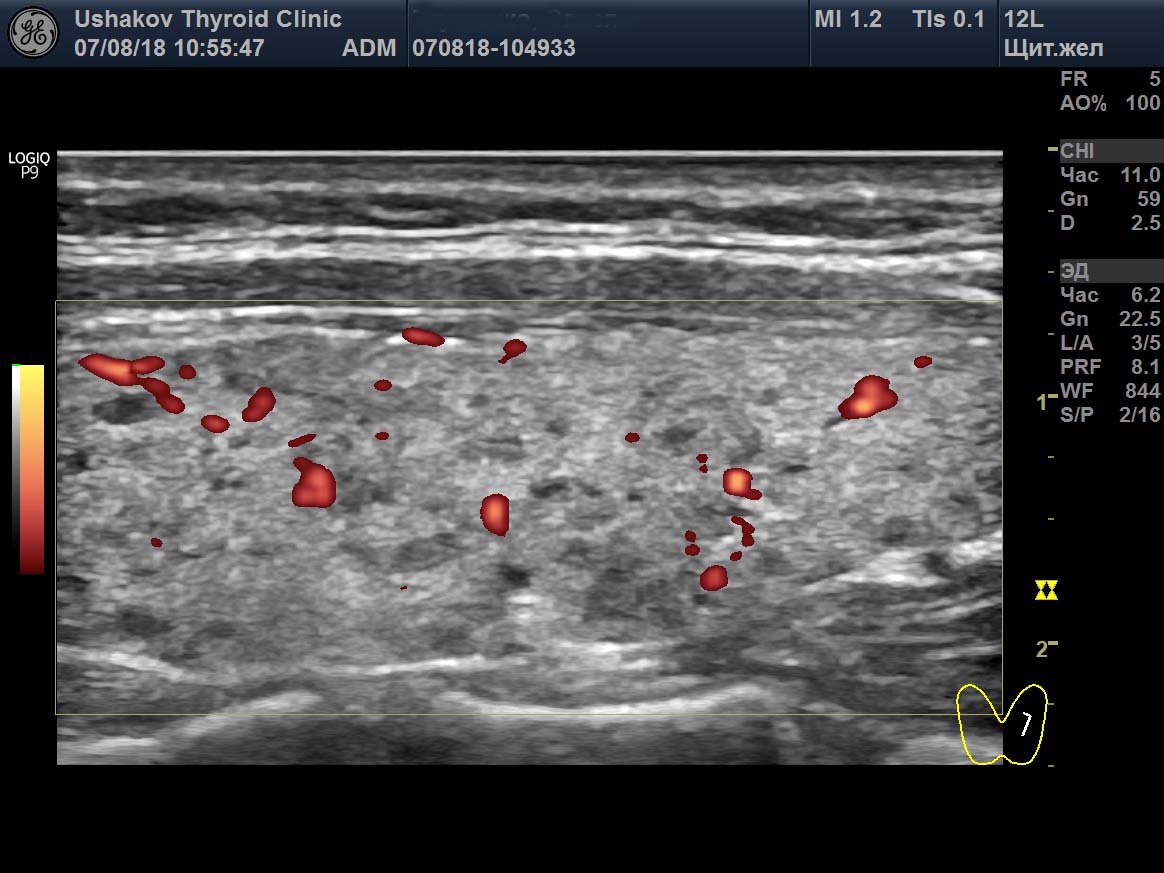Протоколы узи щитовидной железы образцы