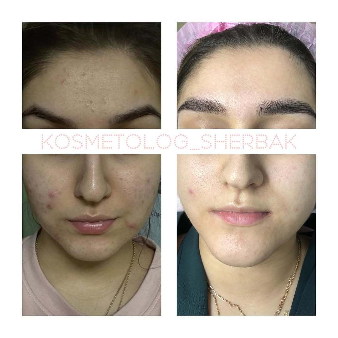 Лечение акне у женщины в клинике PradusCOSMO, СПб. До и после процедуры