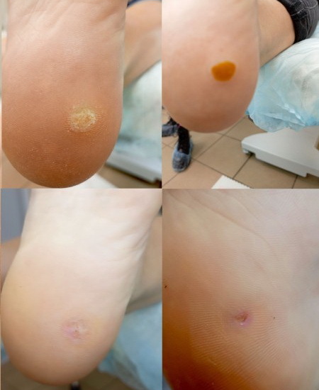 убрать бородавки в Москве