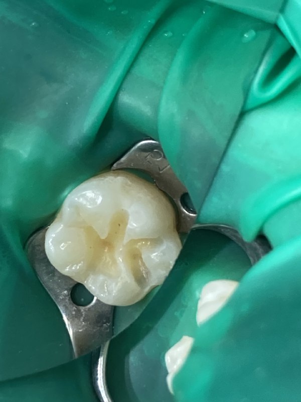 фиссурный кариес 46 зуба