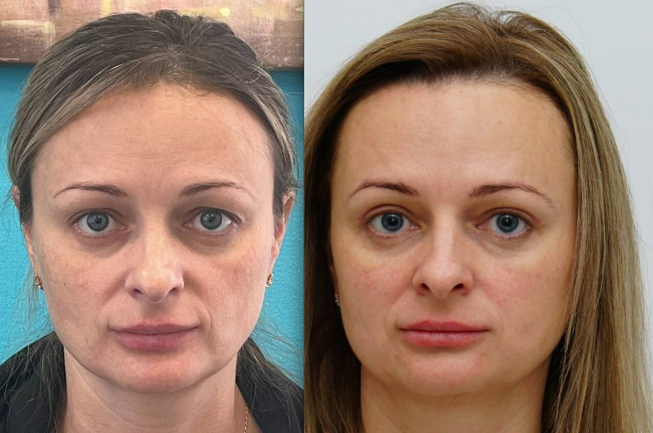 ринопластика горбинка. пластика кончика носа. канал пластический хирург. канал пластический хирург. пластическая хирургия схематично.