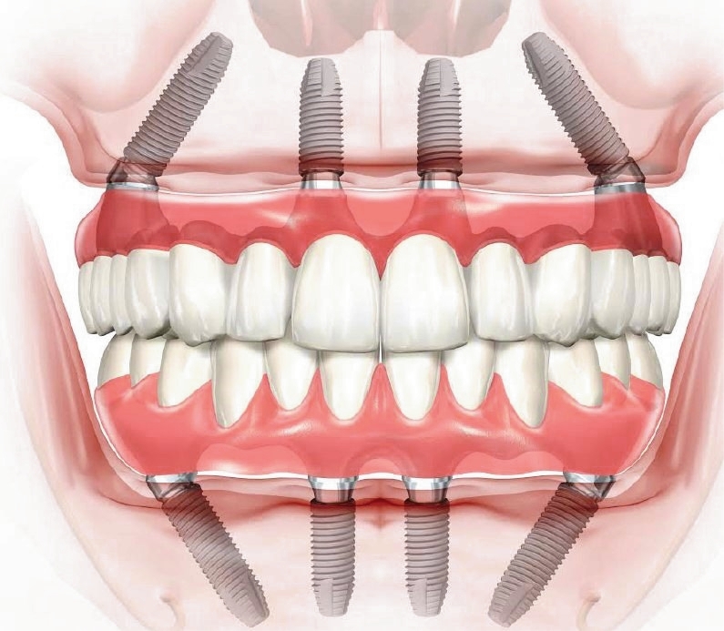 Метод all-on-4 позволяет поставить все зубы за 1 день