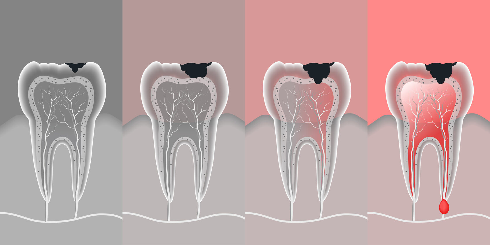 зубная боль стоматология москва пульпит